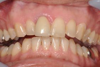 ホワイトニング治療前