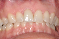 ホワイトニング治療後