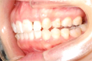 マウスピース矯正・治療後左側
